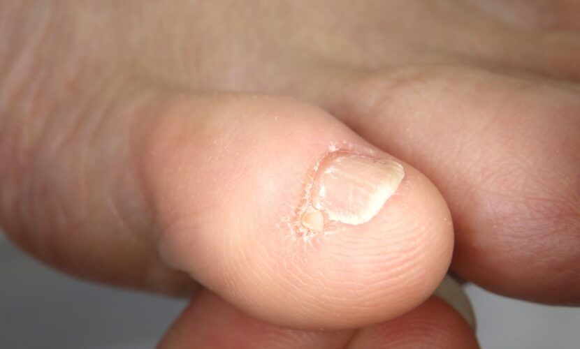 鎌倉市　巻き爪　副爪