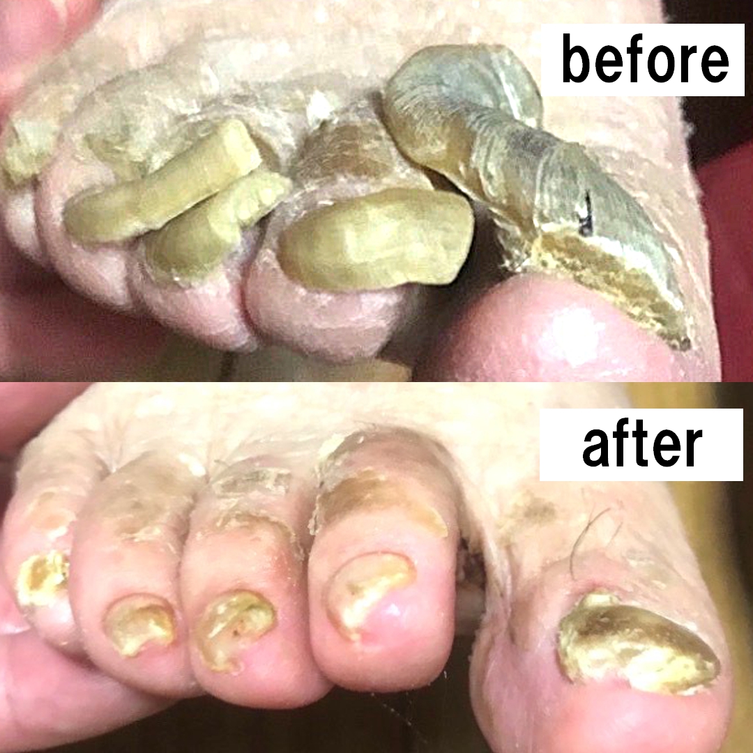 金沢市　巻き爪　ビフォーアフター