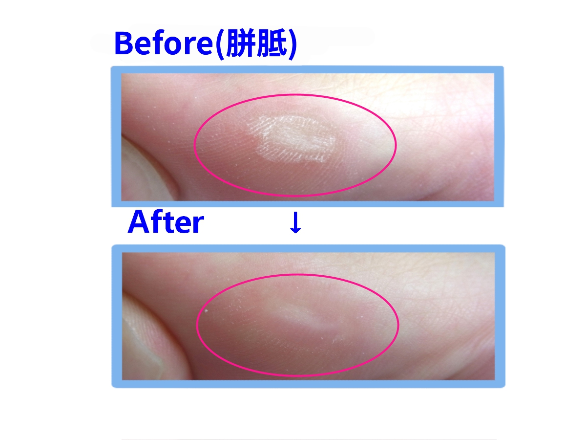 金沢市　巻き爪　ビフォーアフター
