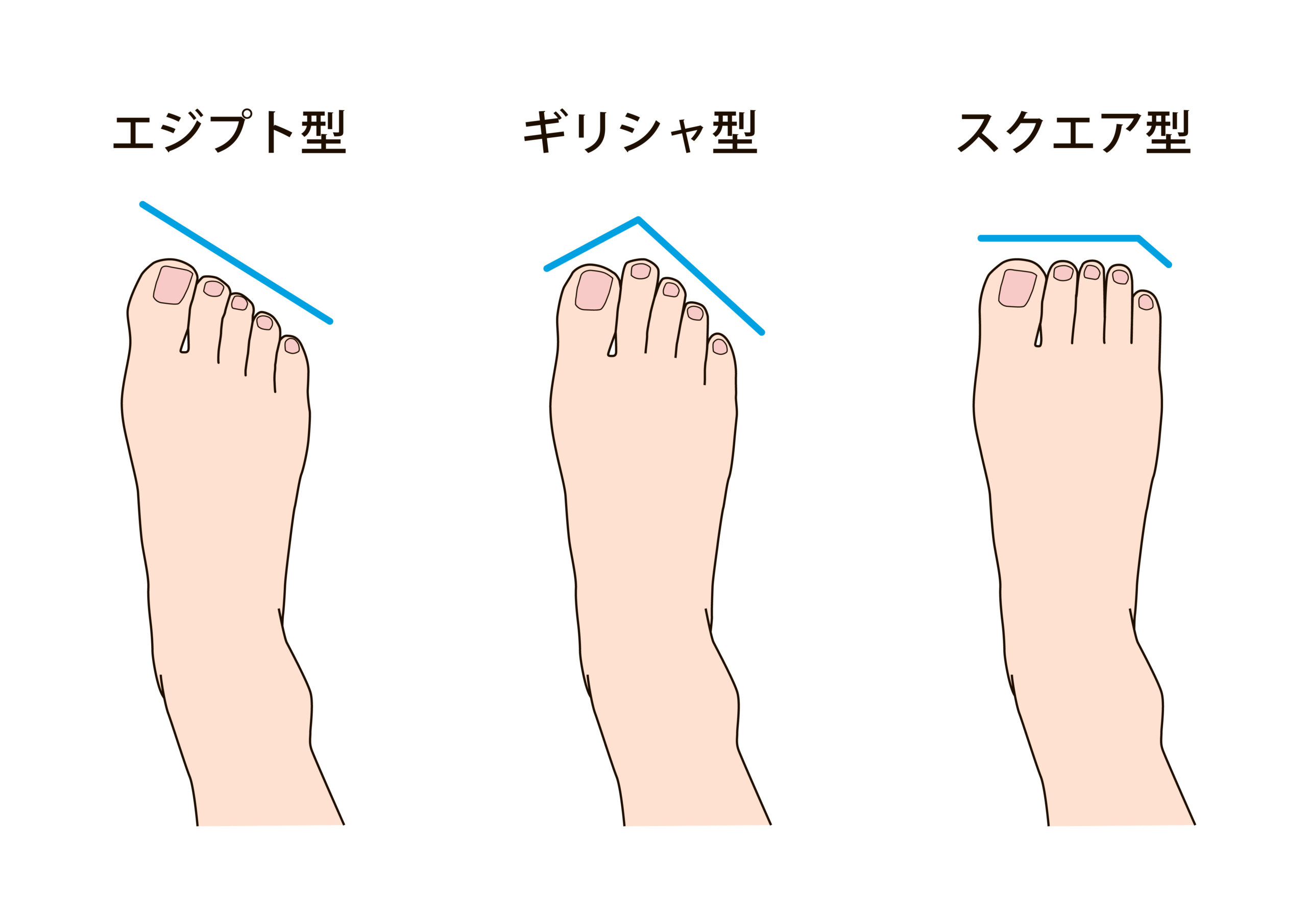 金沢市　巻き爪　足の形