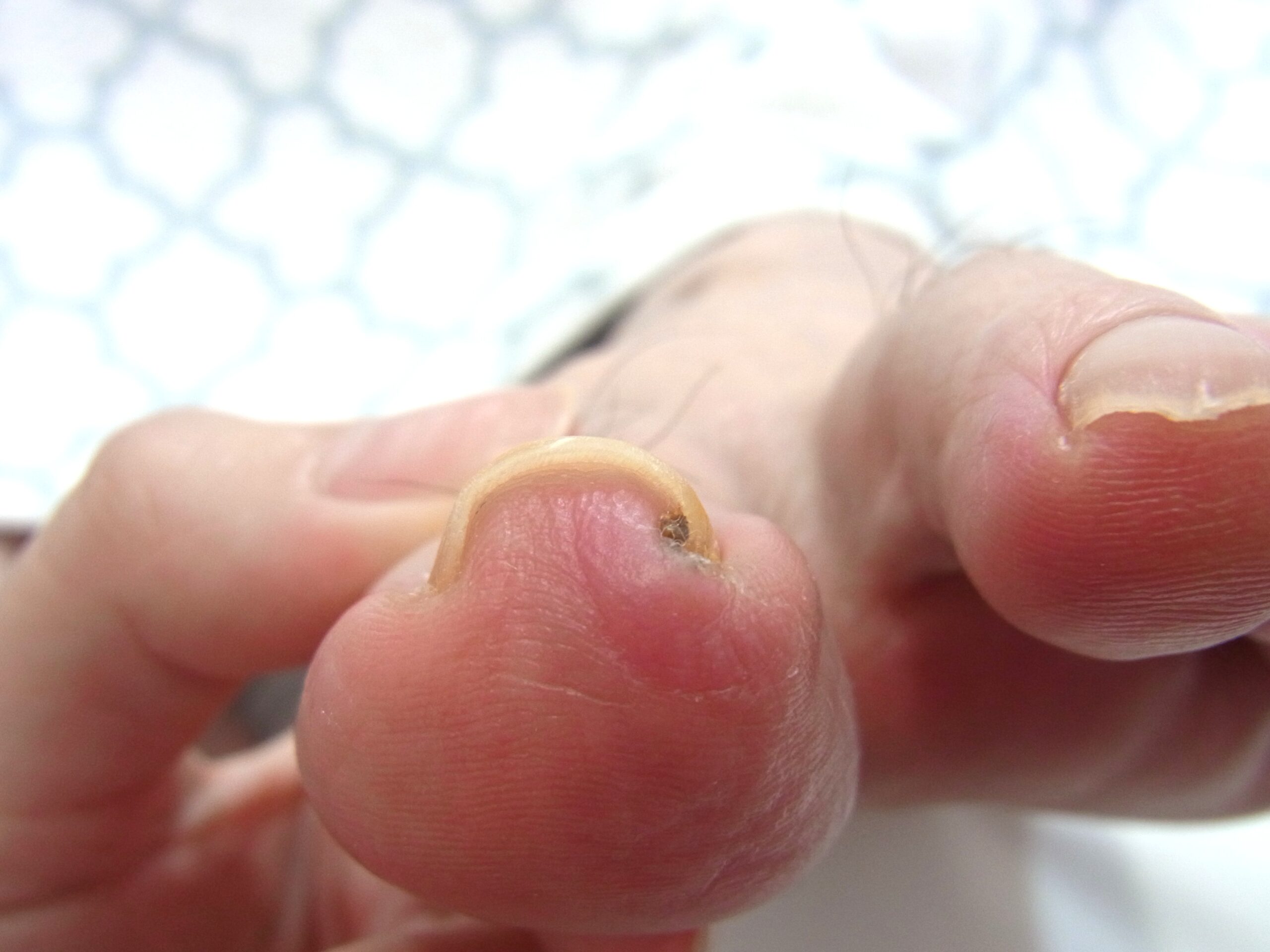 金沢市 巻き爪 ビフォー