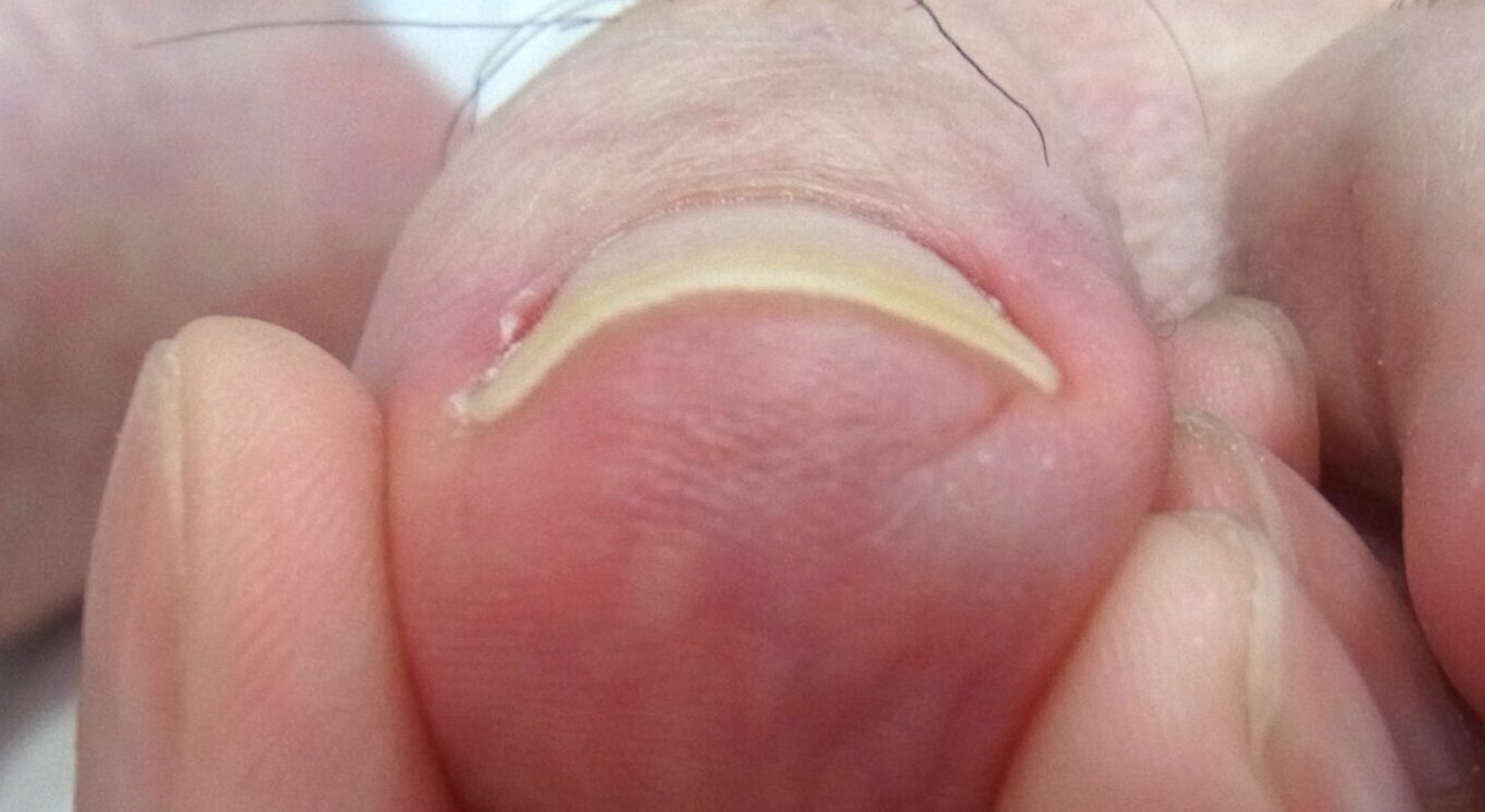 金沢市 巻き爪 アフター