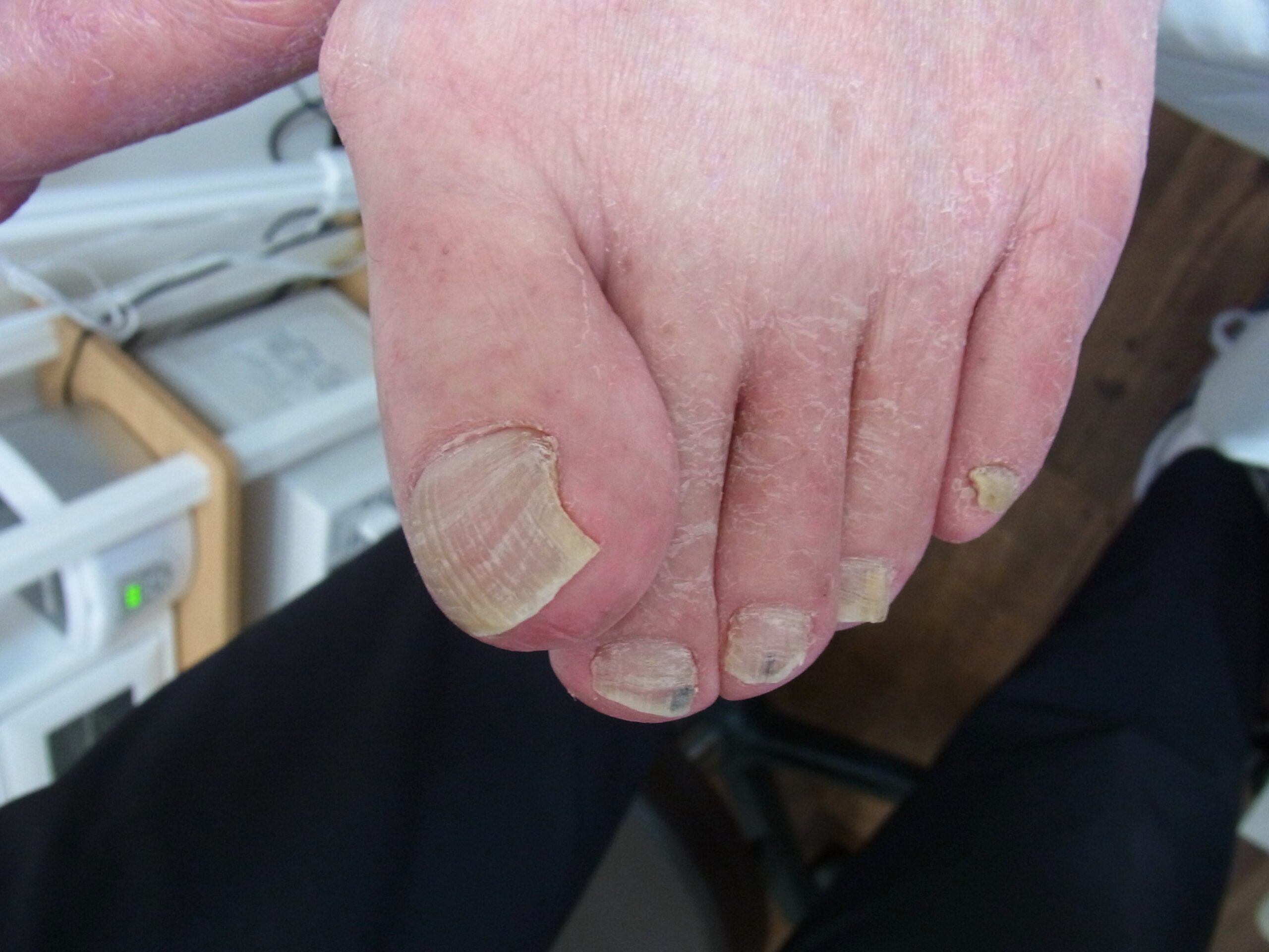 金沢市 巻き爪 ビフォー