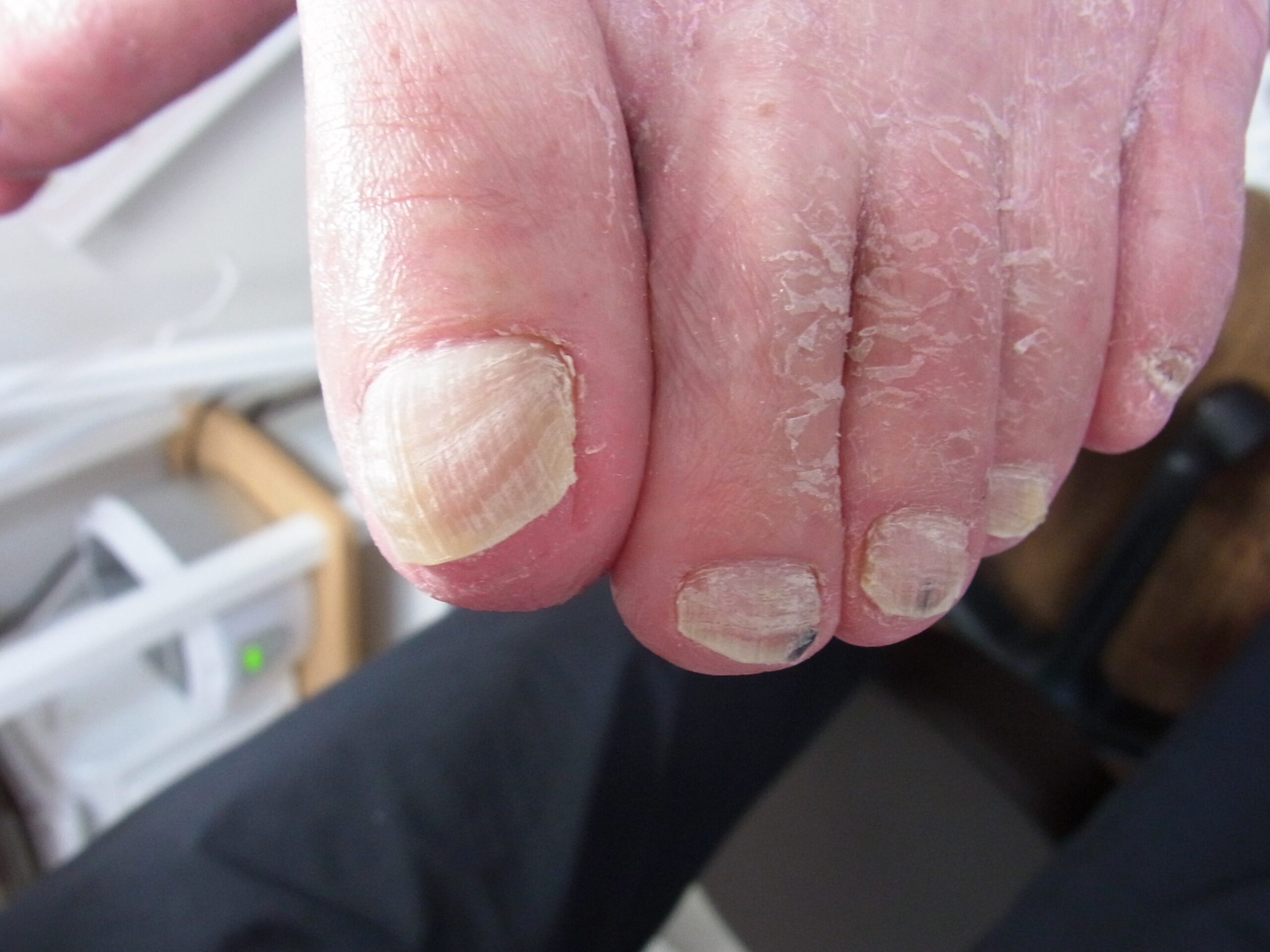 金沢市 巻き爪 アフター