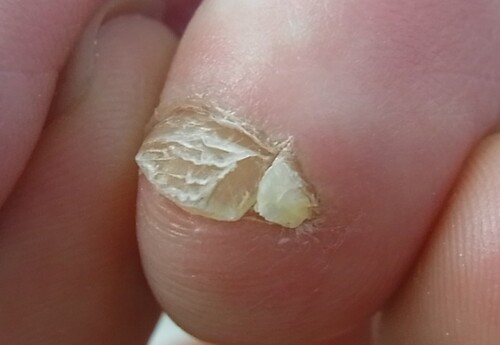 金沢市　巻き爪　副爪