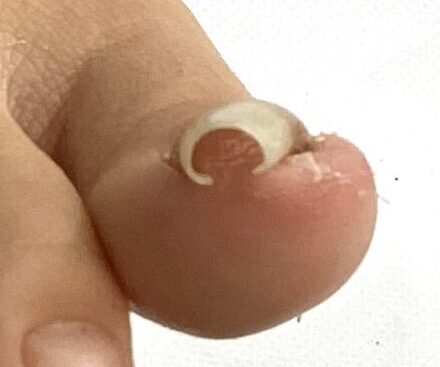 金沢市 巻き爪 ビフォー