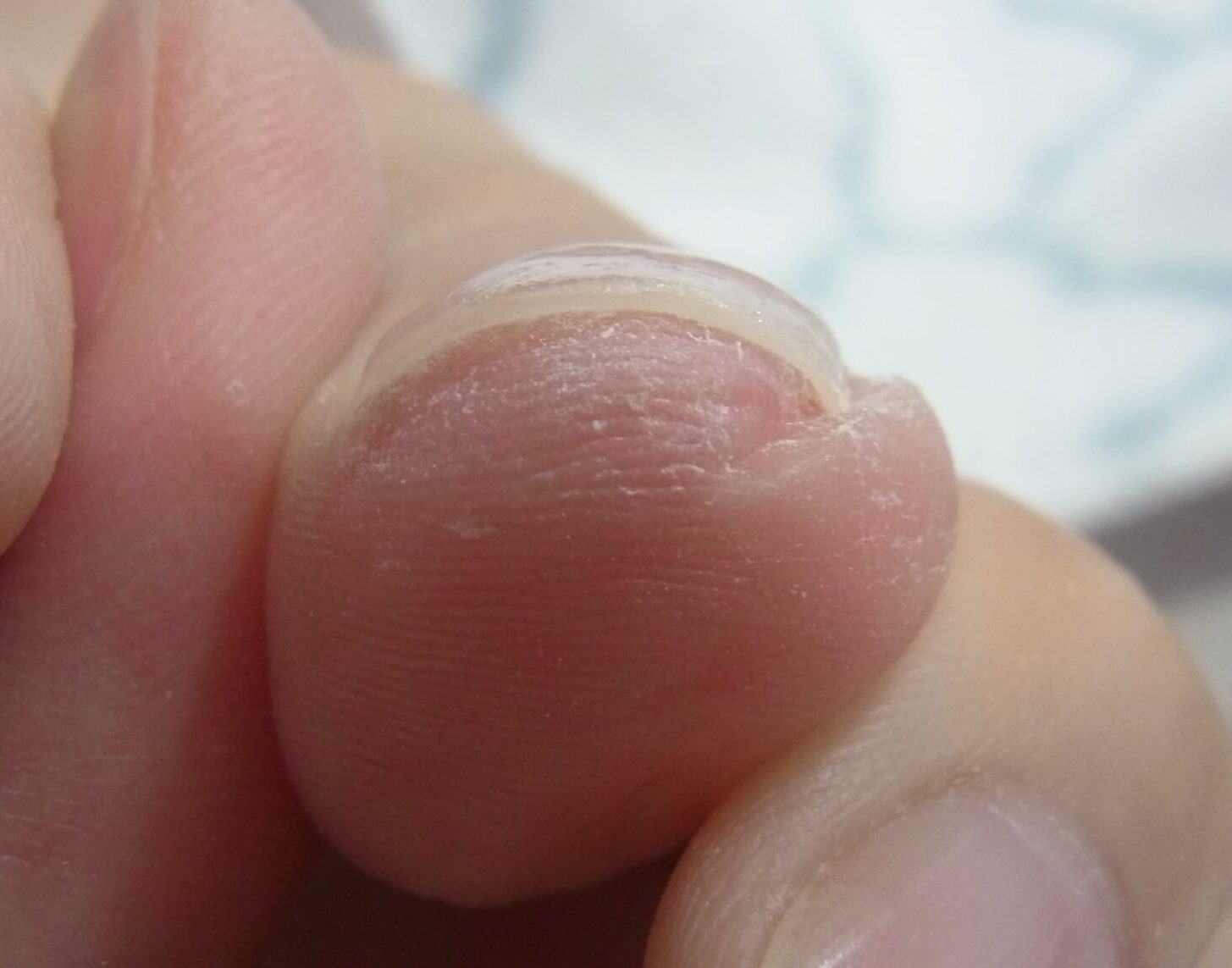 金沢市 巻き爪 アフター