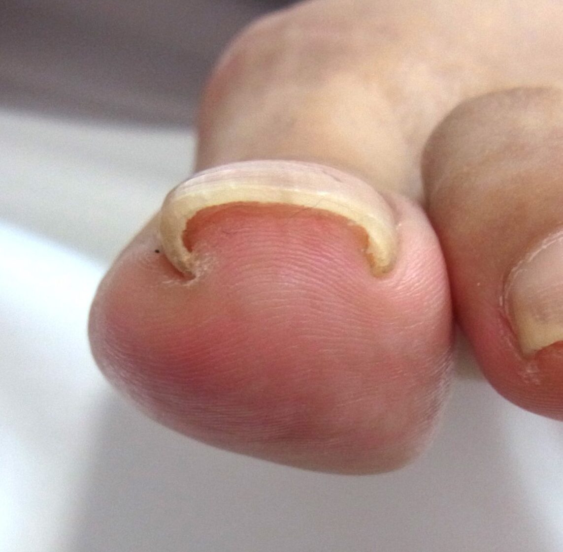 金沢市　巻き爪　ビフォー