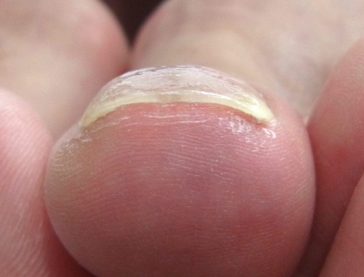 金沢市　巻き爪　アフター