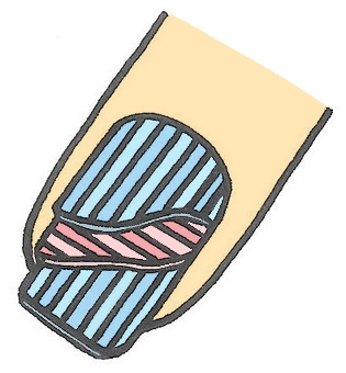 金沢市　巻き爪　爪