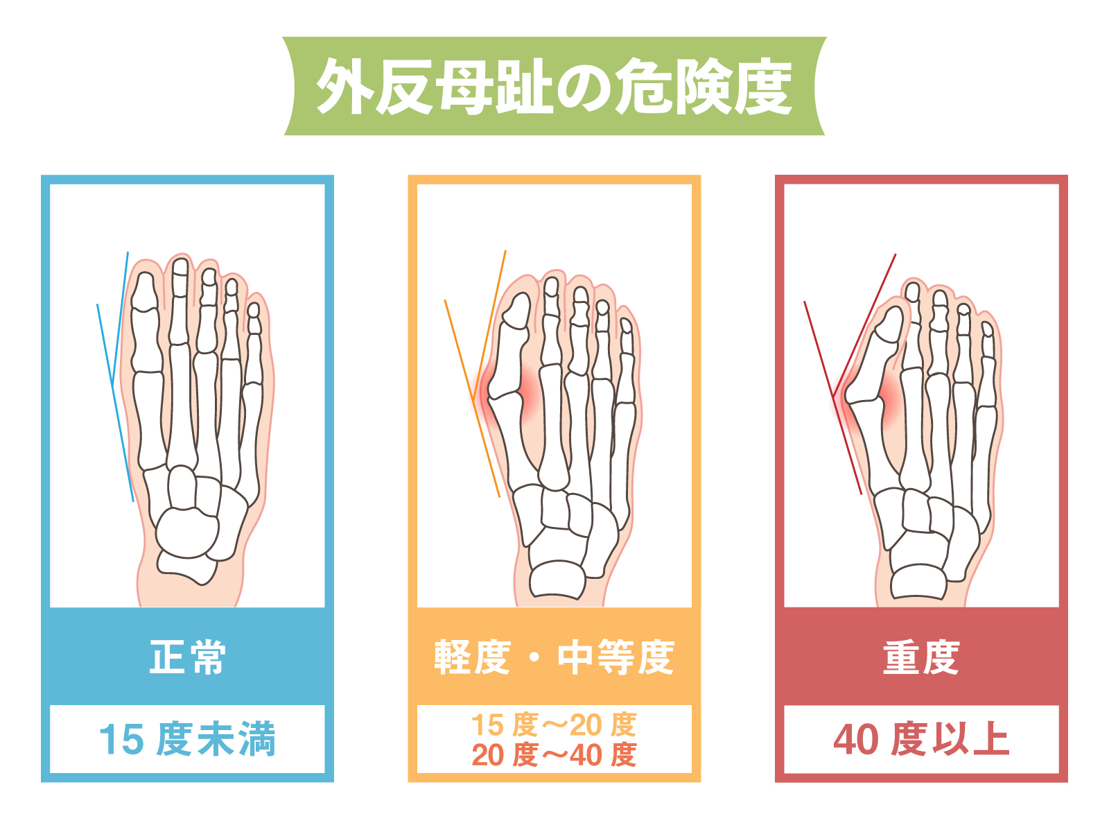 久里浜　巻き爪　外反母趾