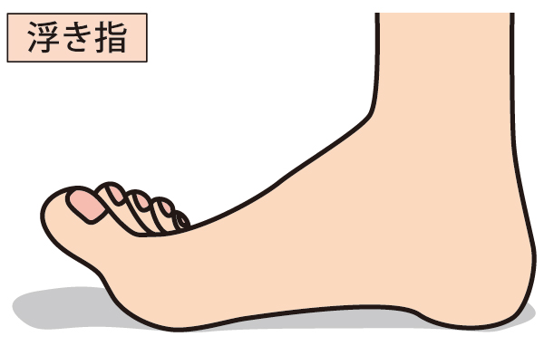 久里浜　巻き爪　浮き指