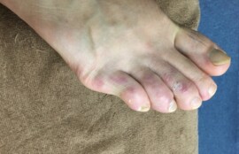 横須賀市久里浜　巻き爪　内反小趾