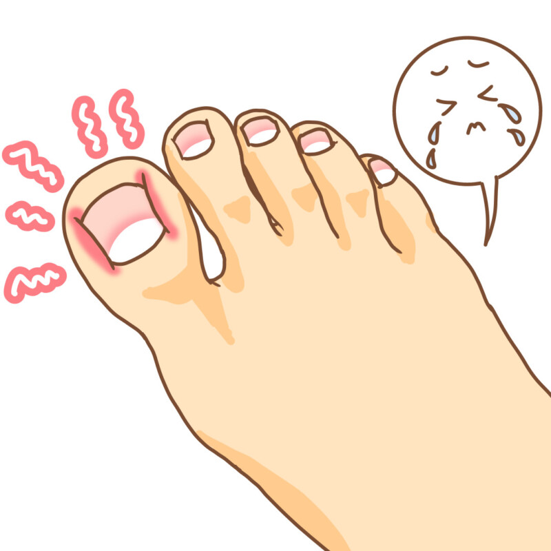久里浜　巻き爪　足