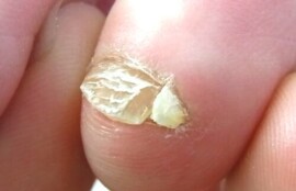 久里浜 巻き爪 副爪