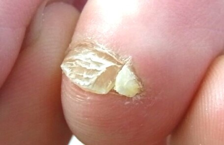 久里浜 巻き爪 副爪