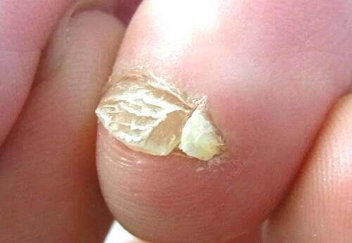 久里浜 巻き爪 副爪