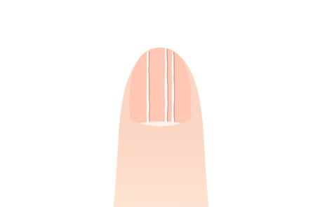 久里浜 巻き爪 爪