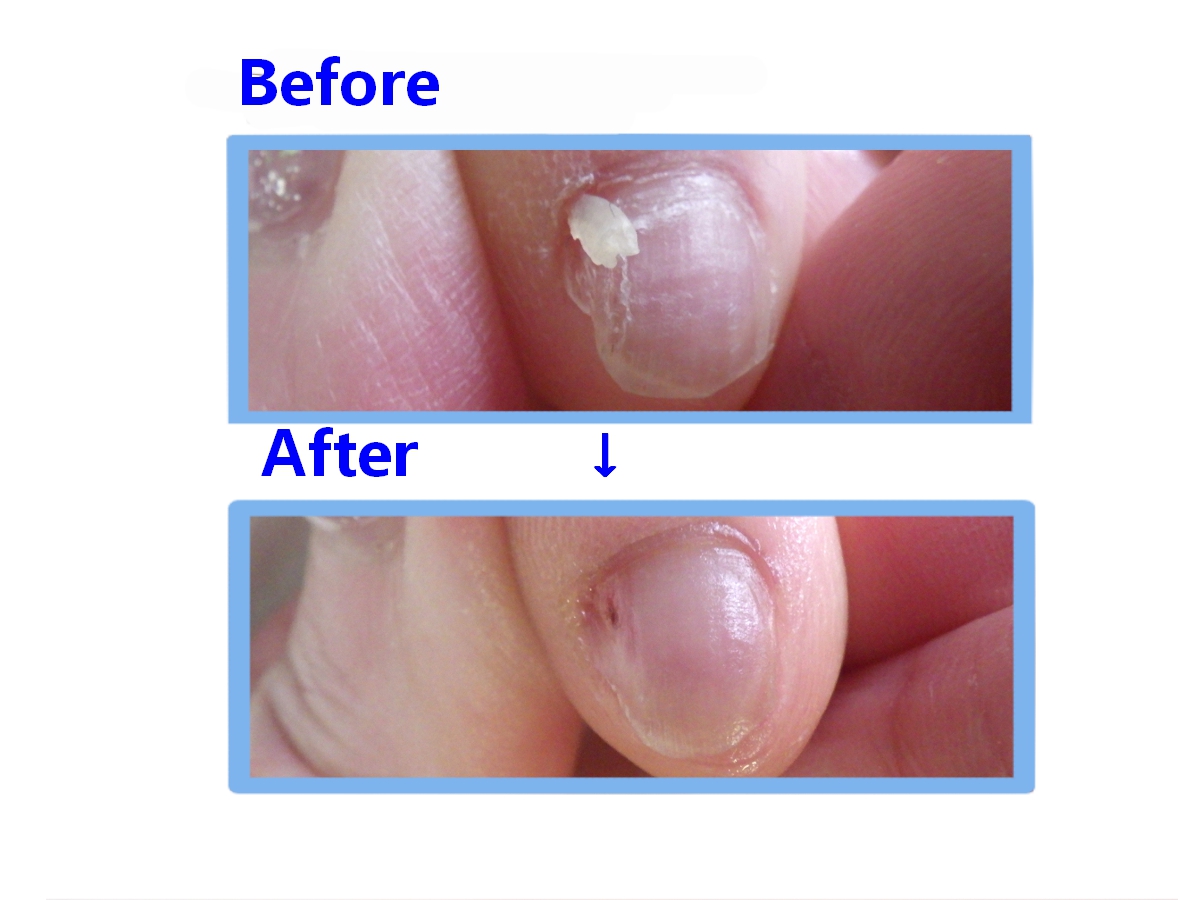 久里浜 巻き爪 副爪