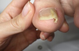 久里浜　巻き爪　ビフォー