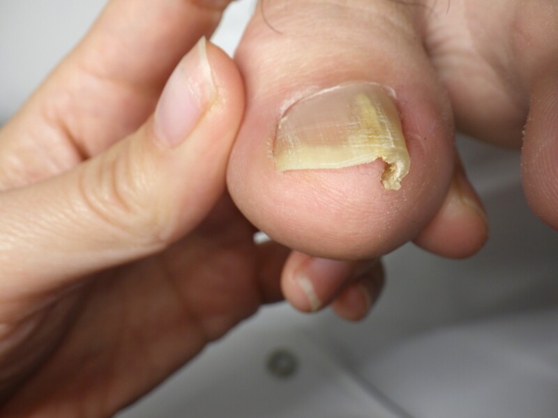 久里浜　巻き爪　ビフォー