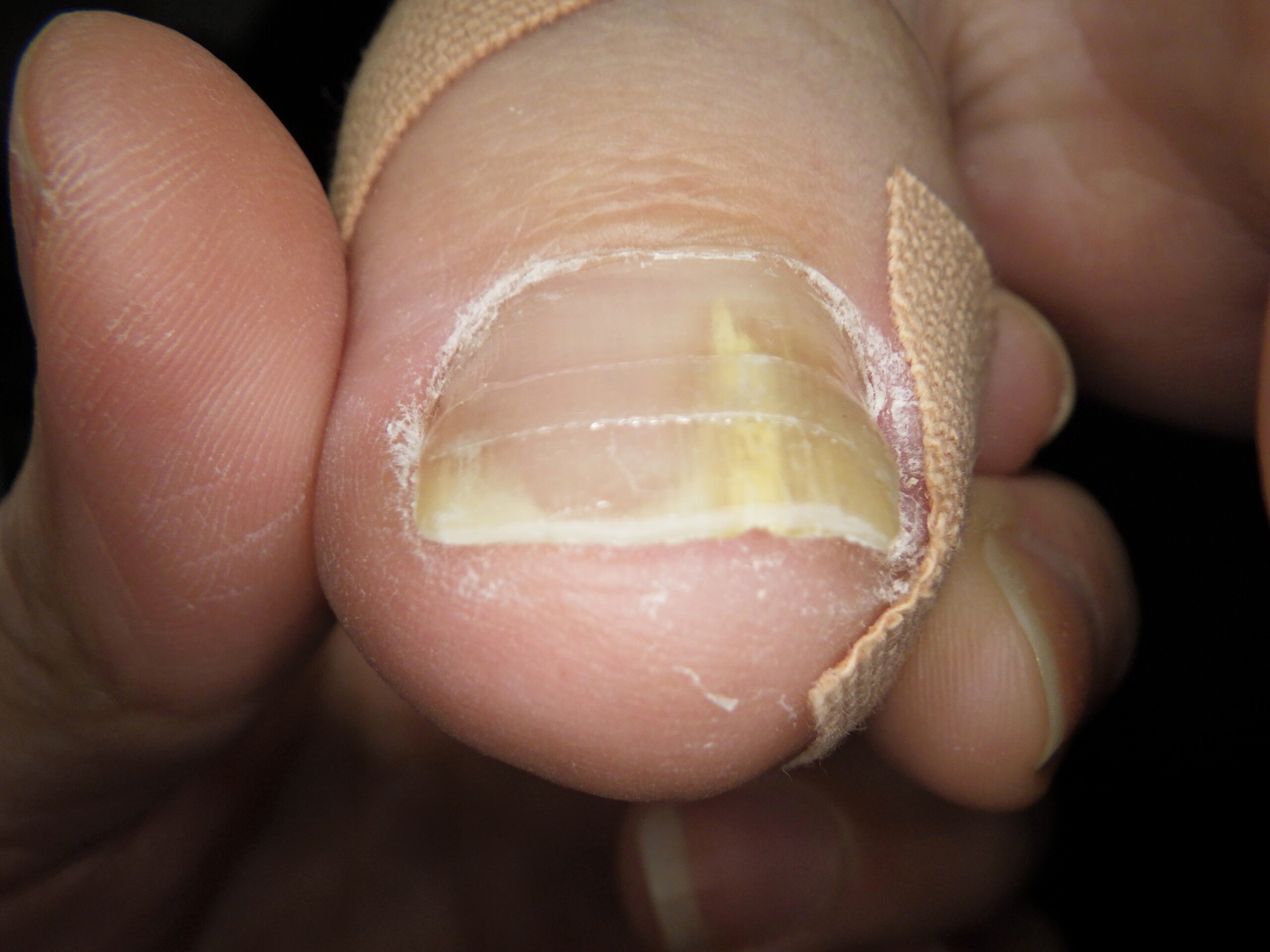 久里浜　巻き爪　アフター