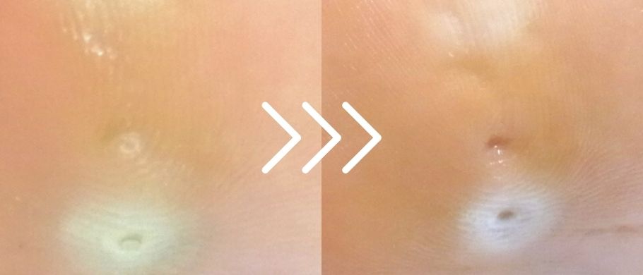 久里浜　巻き爪　魚の目