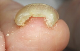 久里浜　巻き爪　ビフォー