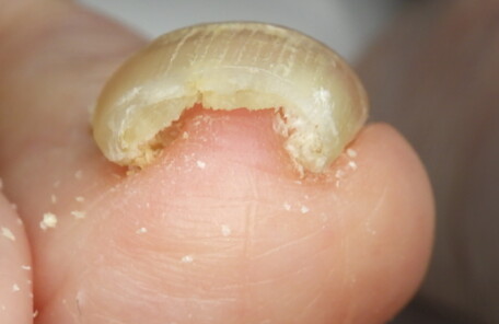 久里浜　巻き爪　ビフォー