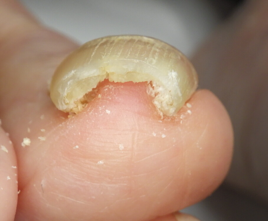 久里浜 巻き爪 ビフォー