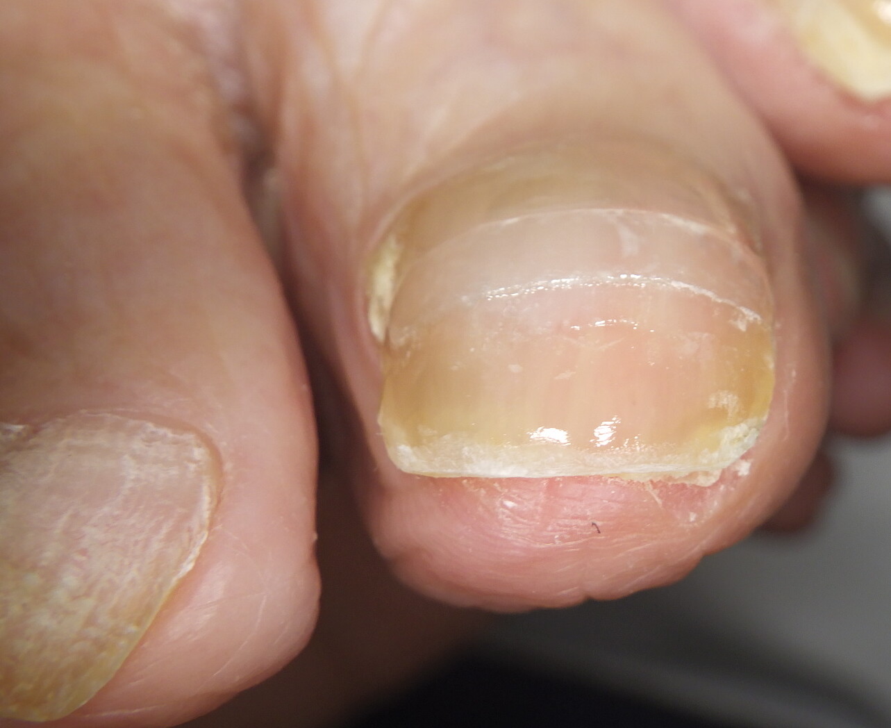 久里浜 巻き爪 アフター