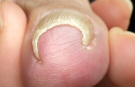 久里浜　巻き爪　ビフォー