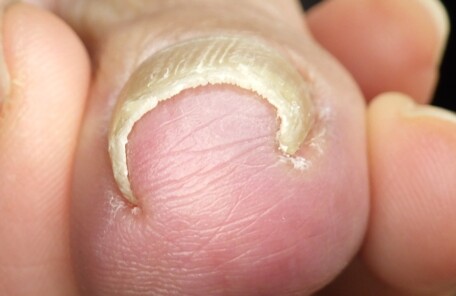 久里浜　巻き爪　ビフォー