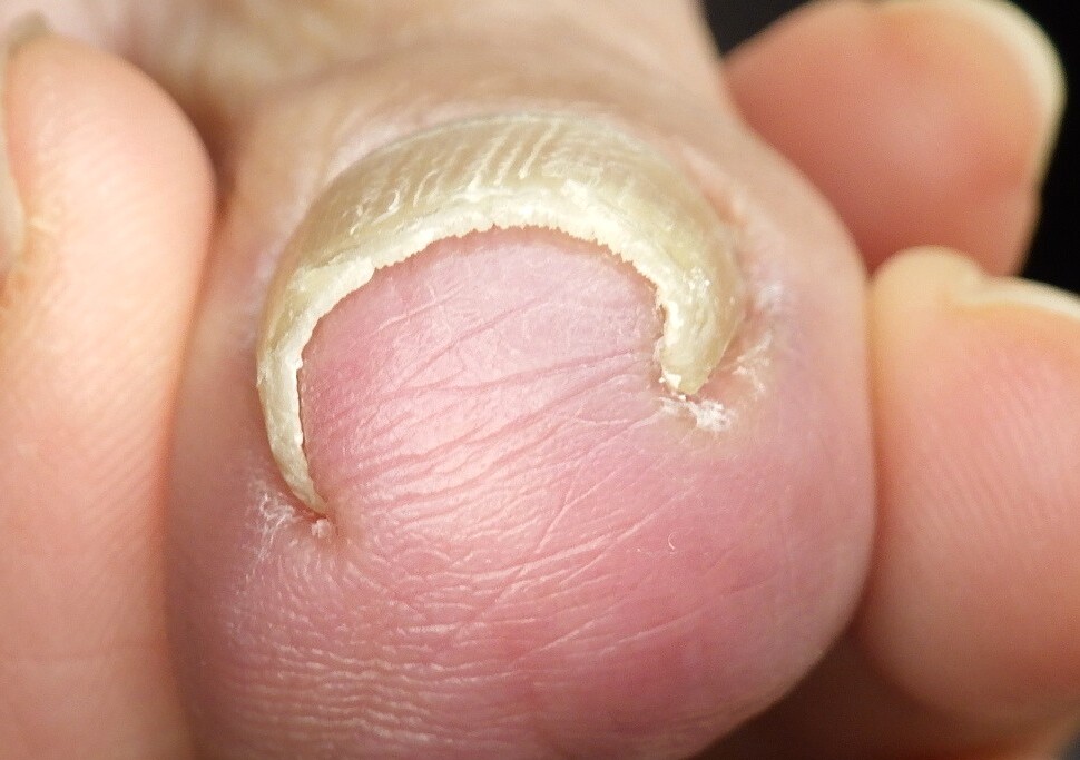 久里浜　巻き爪　ビフォー