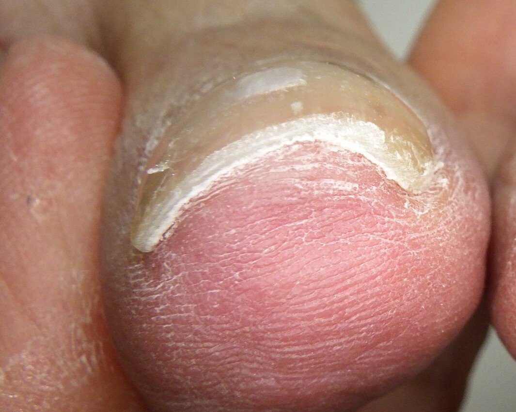 久里浜　巻き爪　アフター