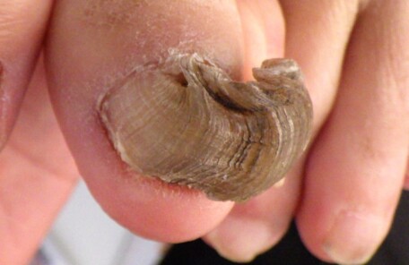 横須賀市久里浜　巻き爪　変形爪