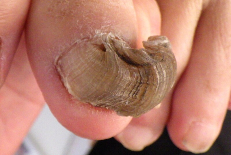 横須賀市久里浜　巻き爪　変形爪