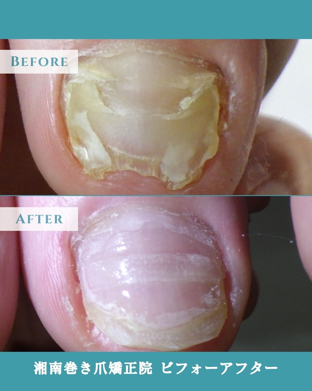 横須賀市久里浜　巻き爪　変形爪