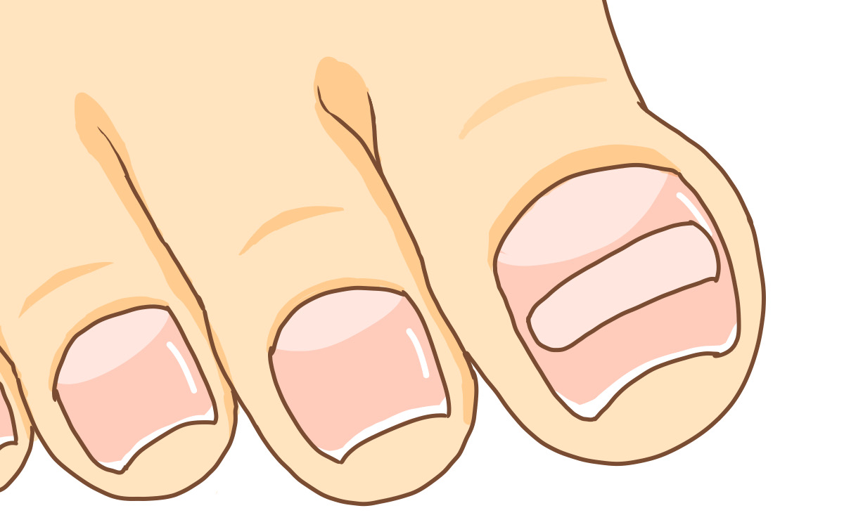 久里浜　巻き爪　プレート