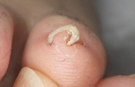 久里浜　巻き爪　ビフォー