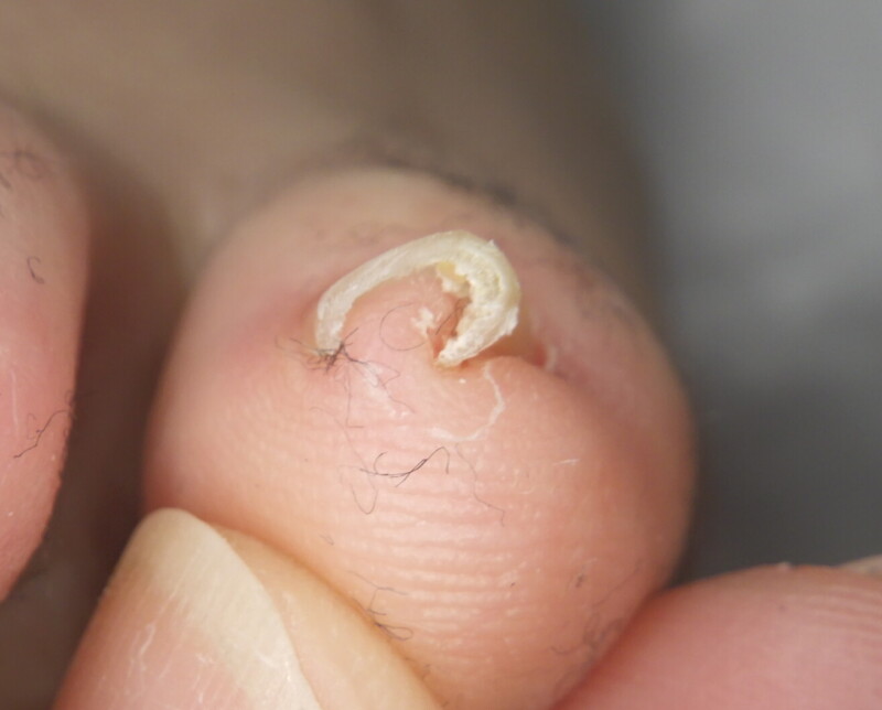 久里浜　巻き爪　ビフォー