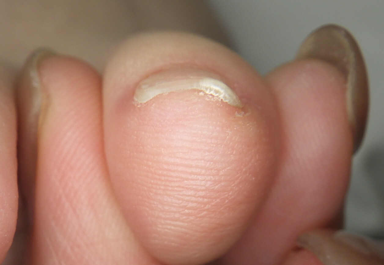 久里浜 巻き爪 アフター