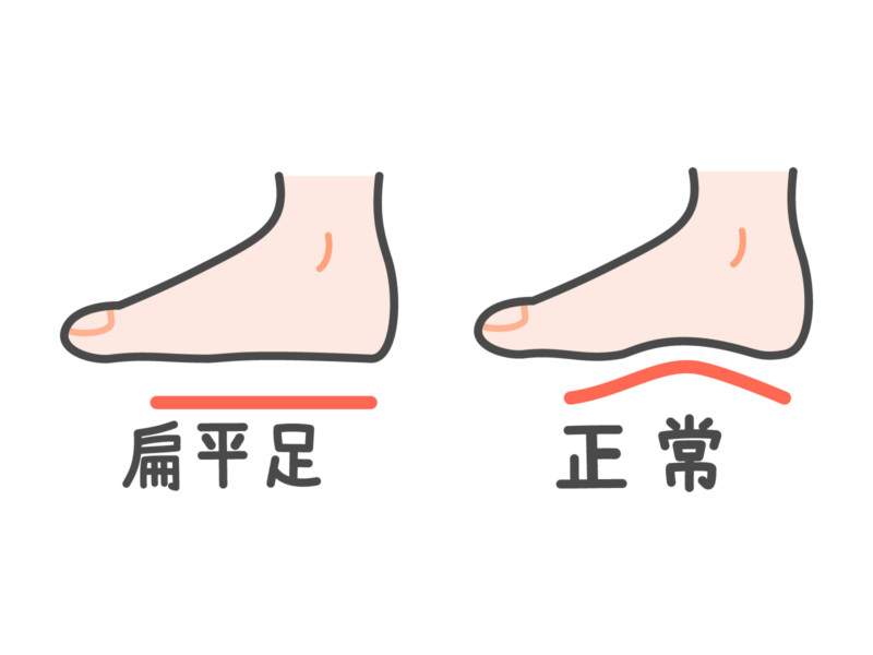 久里浜　巻き爪　扁平足
