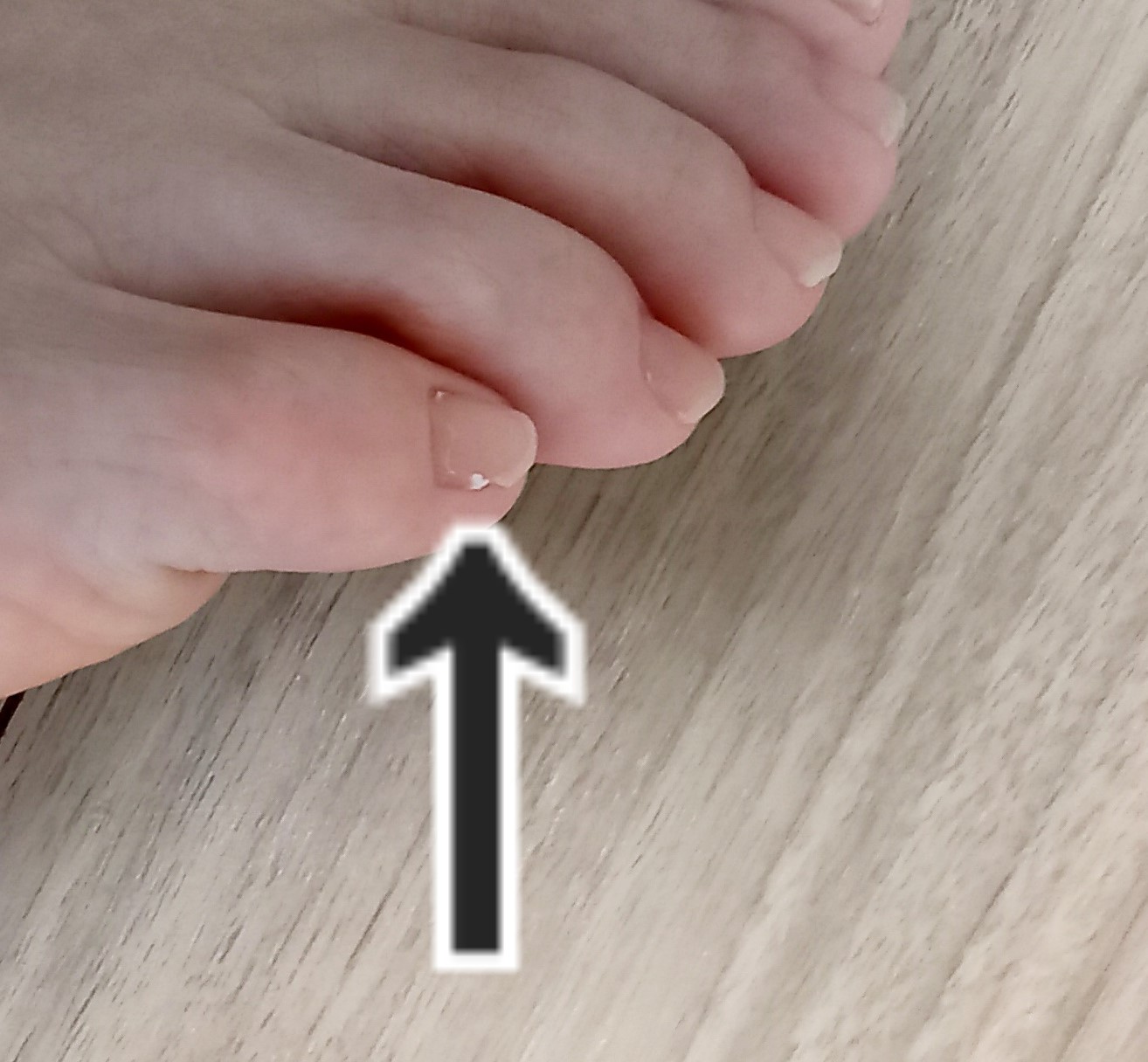 小田原市　巻き爪　副爪