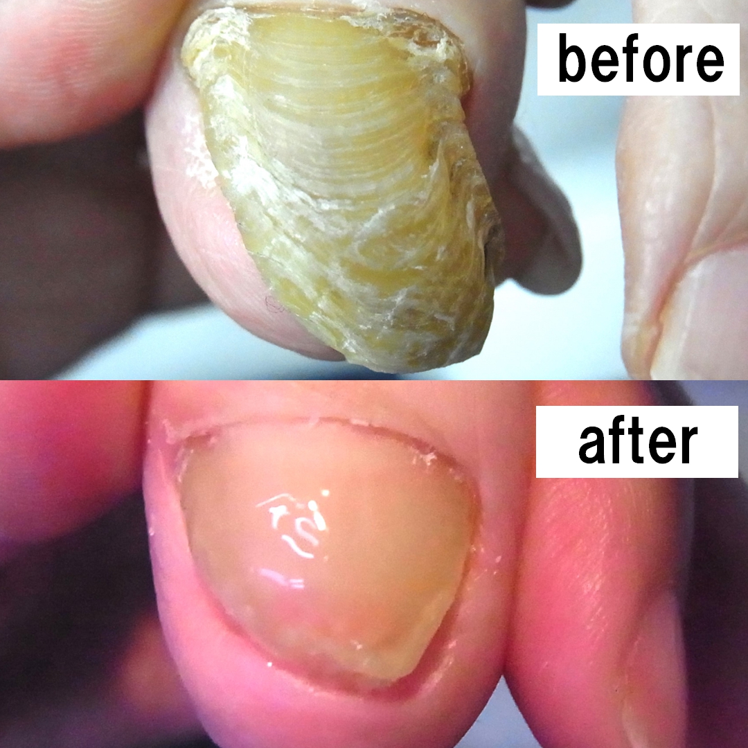 小田原市　巻き爪　ビフォーアフター