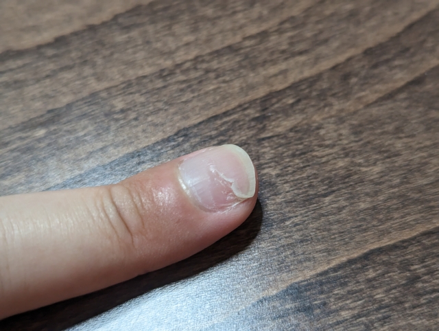 小田原市　巻き爪　割れ爪