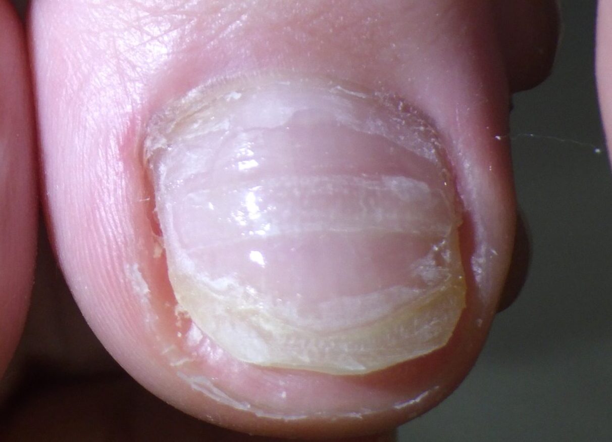 小田原市 巻き爪 アフター