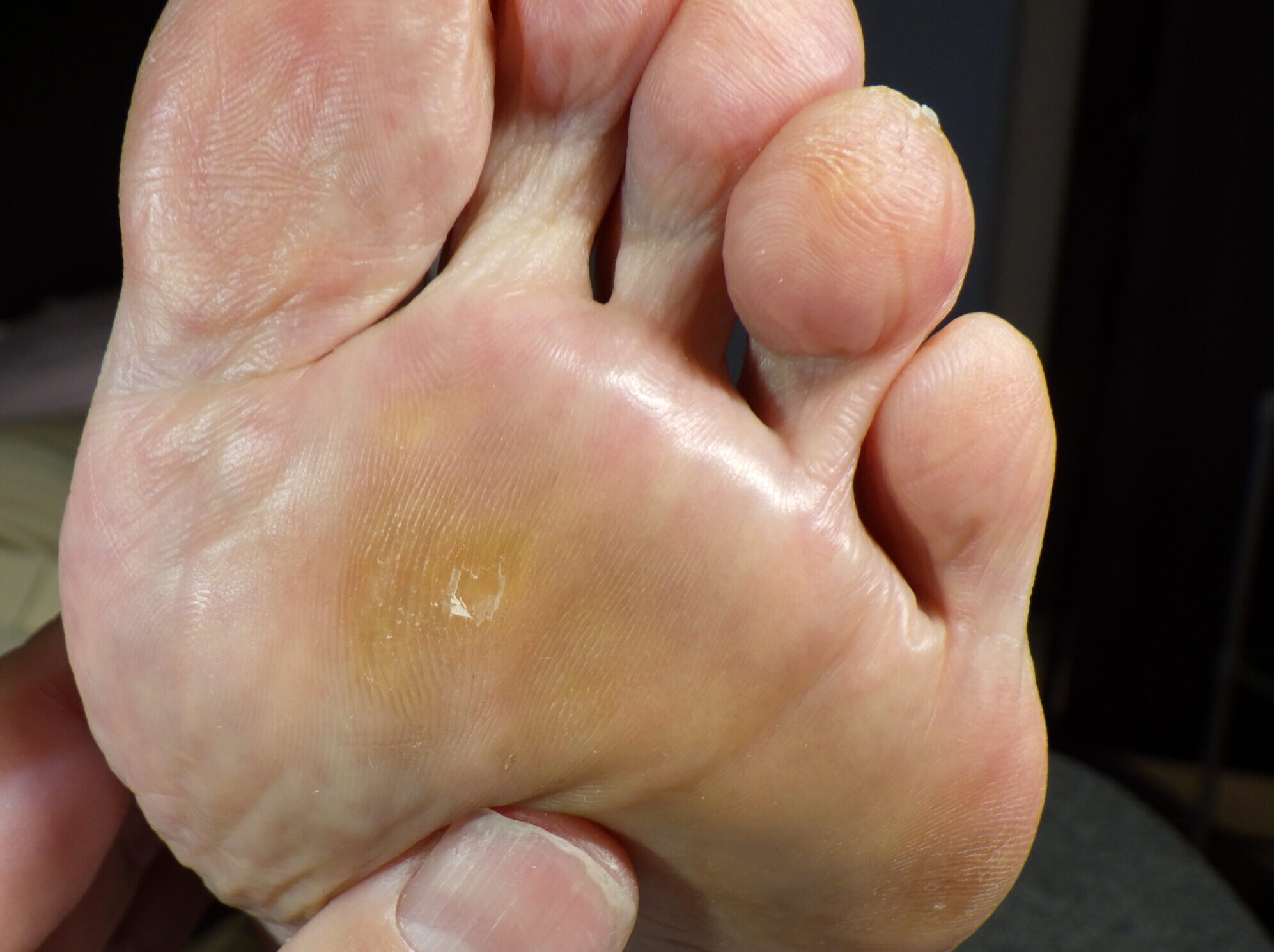 小田原市 巻き爪 ビフォー