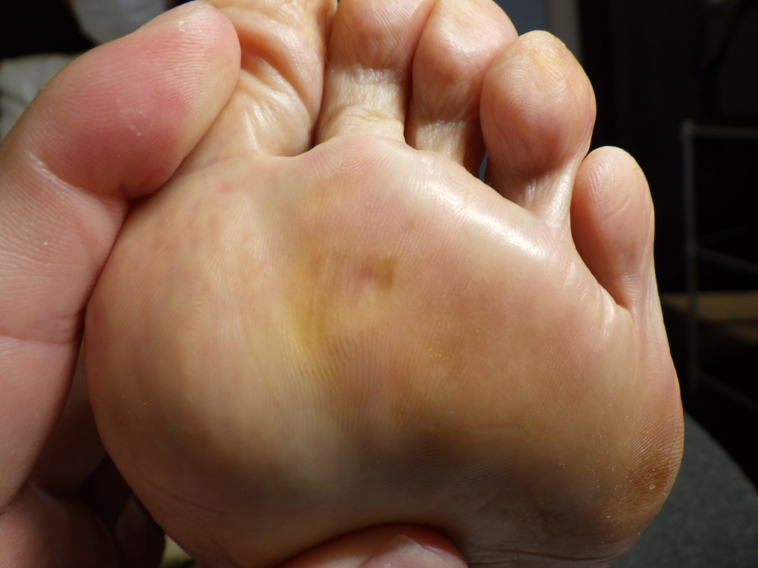 小田原市 巻き爪 アフター