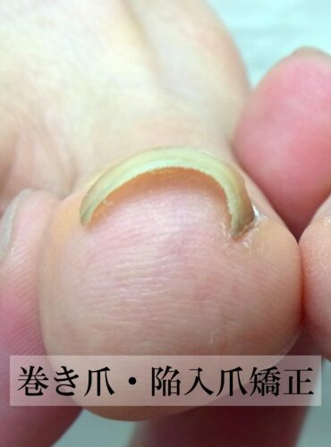 湘南台　巻き爪　症例